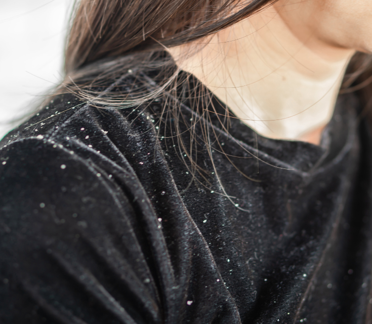 Dandruff
